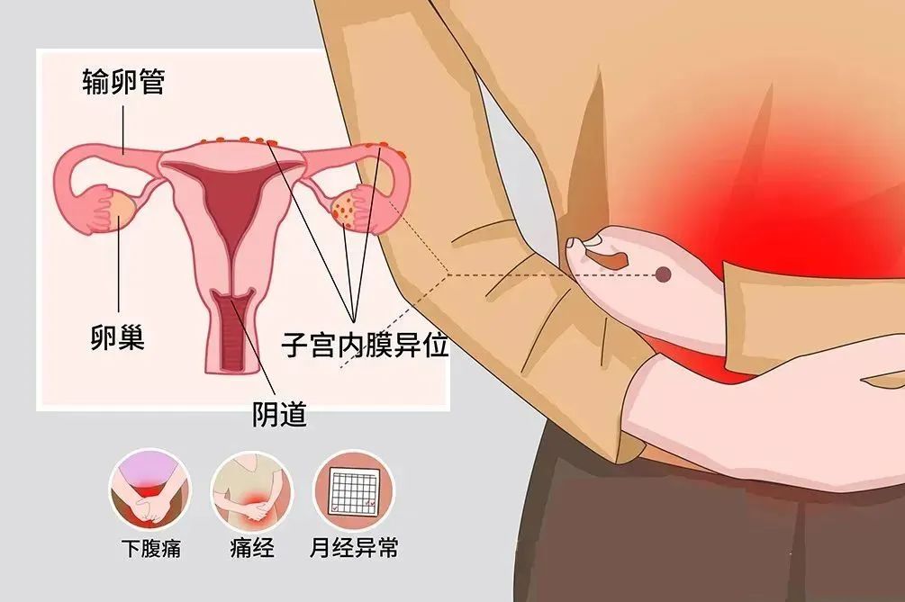 子宫内膜异位症.jpg