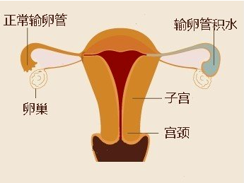 一篇文章详解输卵管积液